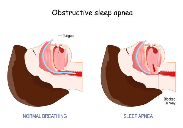 Obstructive sleep apnea