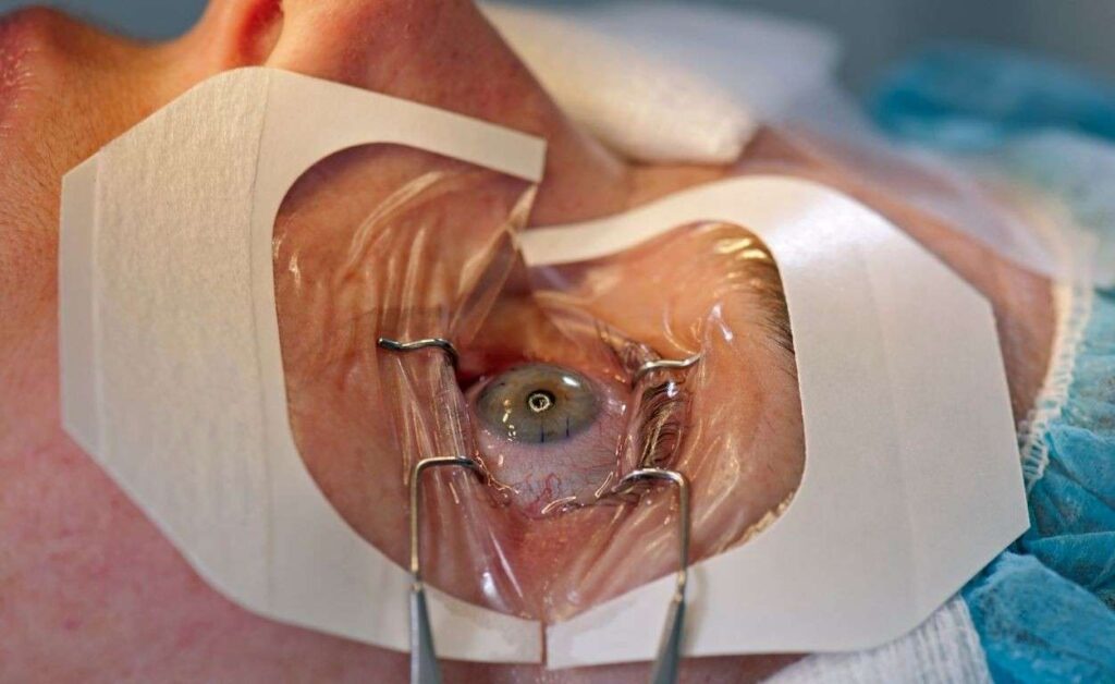 laser eye surgery