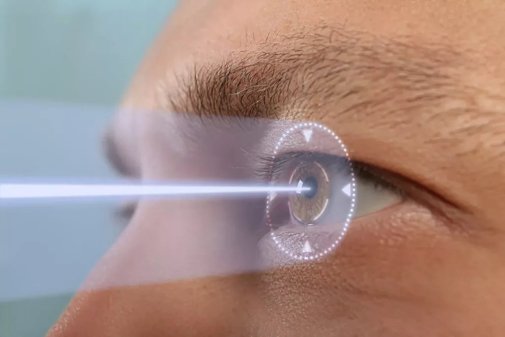 laser eye surgery